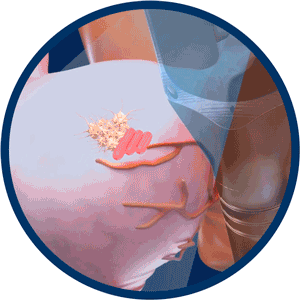 GIF animation of high intensity focused ultrasound killing the cancer cells